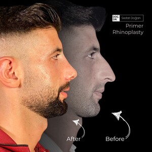 Image of Primer Rhinoplasty - Dr Sedat Doğan