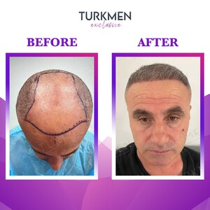 Image of Turkmen Hair Transplant Gallery 2