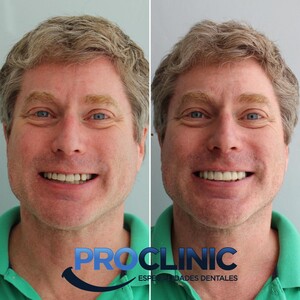 Image of Temporary teeth for smile design with porcelain dental veneers