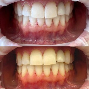 Image of Teeth whitening - Warsaw Dental Academy