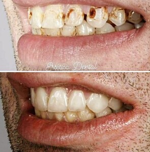 Image of Teeth whitening