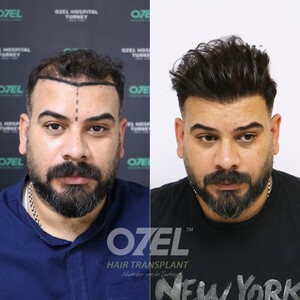 Image of Ozel Hair Transplant Gallery 3