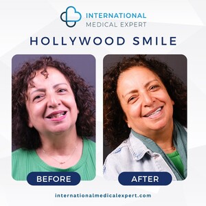 Image of Hollywood Smile makeover before and after