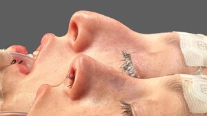 Image of Rhinoplasty - Porto Nose Clinic