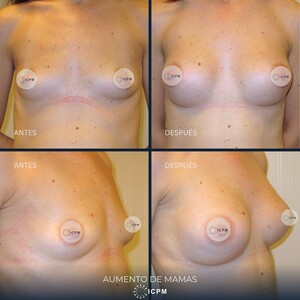 Image of Breast implants