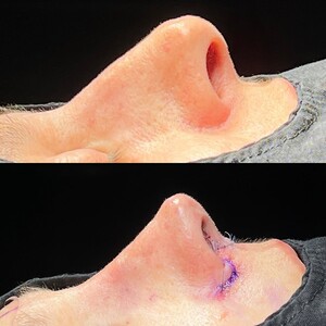 Image of Ultrasonic rhinoplasty