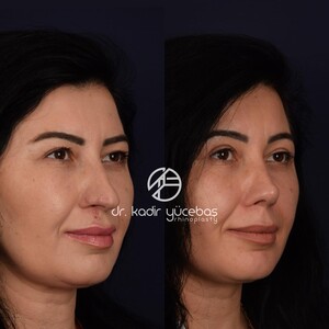 Image of Nose surgery - Dr. Kadir Yücebaş