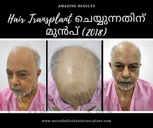 Image of Micro Follicle Hair Transplant Gallery 2