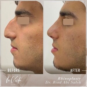 Image of Before and After Rhinoplasty