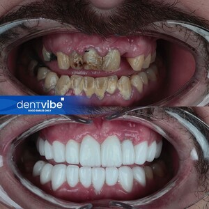 Image of Hollywood smile