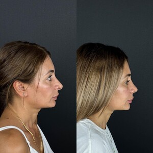 Image of Umman Tunç - Rhinoplasty Clinic Gallery 2