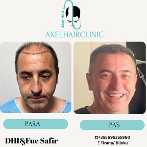 Image of Akel Hair Clinic Tirana Gallery 2