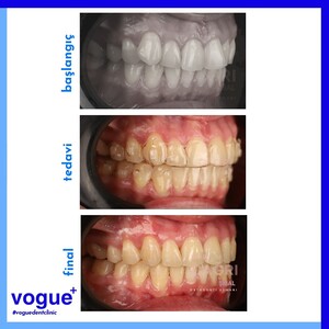 Image of Orthodontic treatment