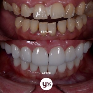 Image of Veneers before and after