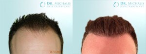 Image of Dr. Michalis Hair Transplant Gallery 2