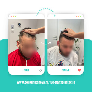 Image of FUE Hair transplant