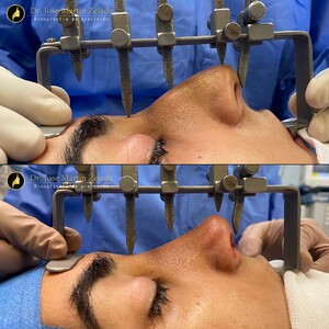 Image of Nose correction 