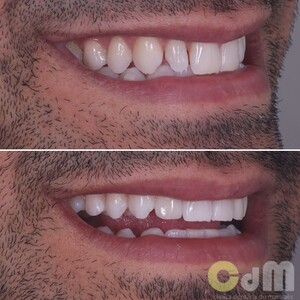 Image of Dental treatment before and after