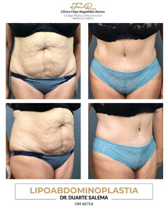 Image of Lipoabdominoplasty - FMR Clinic