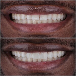 Image of Composite Veneers