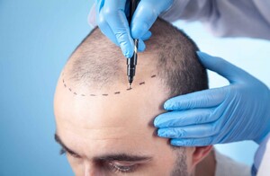 Image of Genesis Hair Transplant Gallery 3