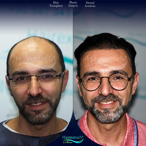 Image of HairextreM Hairtransplant Center Gallery 4