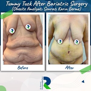 Image of Tummy Tuck, Dr Remzi Fırıncıoğulları