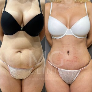 Image of Tummy tuck - MG Clinic 