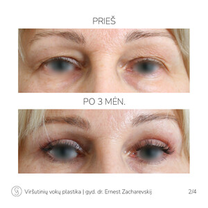 Image of Eyelid Surgery - SV Plastic Surgery Center