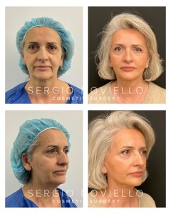 Image of Facelift