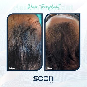 Image of Hair transplant before and after