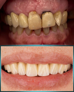 Image of Hollywood Smile - Dr Popovic