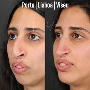 Image of Nose job - Porto Nose Clinic