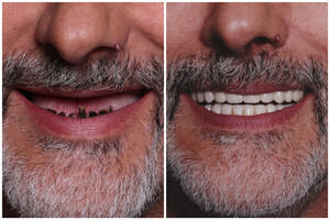 Image of All on 4 dental implants - IDC Ruzevic