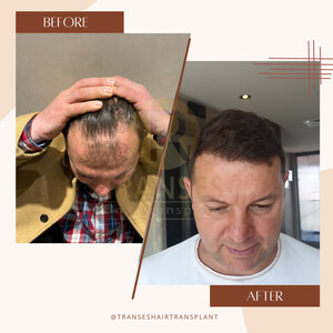 Image of Transes Hair Transplant Gallery 2