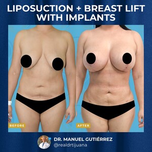 Image of Liposuction and Breast Lift with Implants