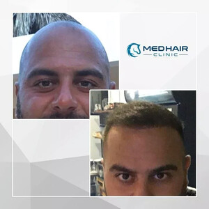 Image of Medhair Clinic Hair Transplant Gallery 1