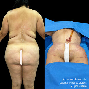 Image of Secondary abdominoplasty, butt lift, liposculpture