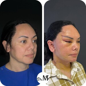 Image of Face lift and neck lift