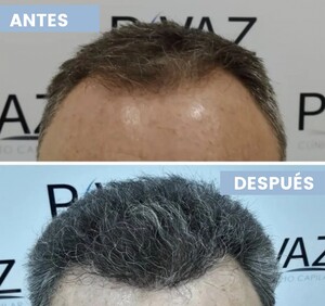 Image of Hair transplant