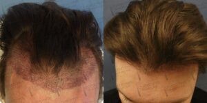 Image of FUE Hair Transplantation - Legend Hair Transplant