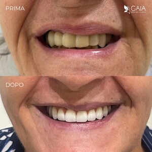 Image of Hollywood smile