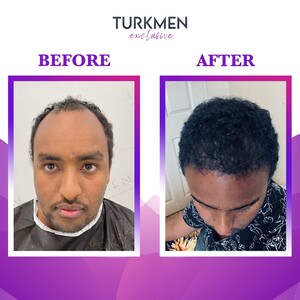 Image of Turkmen Hair Transplant Gallery 0