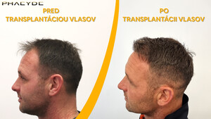 Image of Before after hair transplant - Phaeyde Clinic