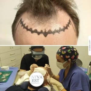 Image of Hair transplant surgery