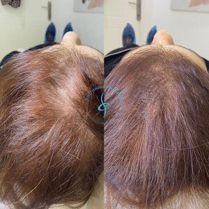 Image of Hair loss treatment for women