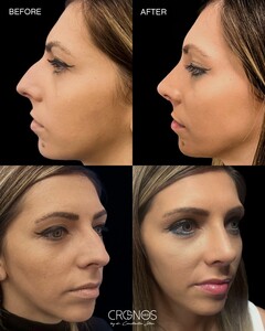 Image of Rhinoplasty - Cronos Med 