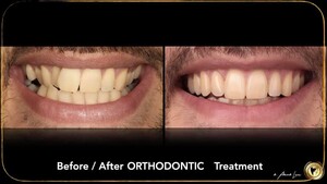 Image of Orthodontic treatment -  Dr. Aleksandrs Lavrovs