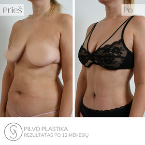 Image of Mommy Makeover - SV Plastic Surgery Center