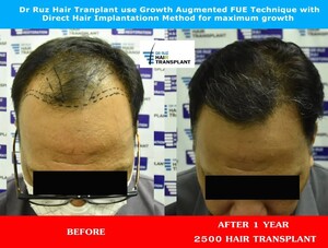 Image of Dr Ruz Hair Transplant Gallery 2